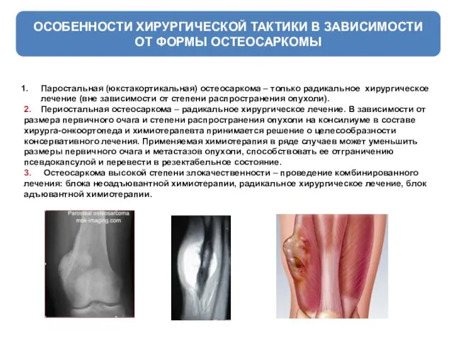 ОСОБЕННОСТИ ХИРУРГИЧЕСКОЙ ТАКТИКИ В ЗАВИСИМОСТИ ОТ ФОРМЫ ОСТЕОСАРКОМЫ Паростальная (юкстакортикальная) остеосаркома