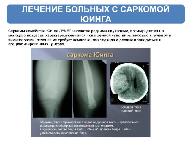 ЛЕЧЕНИЕ БОЛЬНЫХ С САРКОМОЙ ЮИНГА Саркомы семейства Юинга / PNET являются