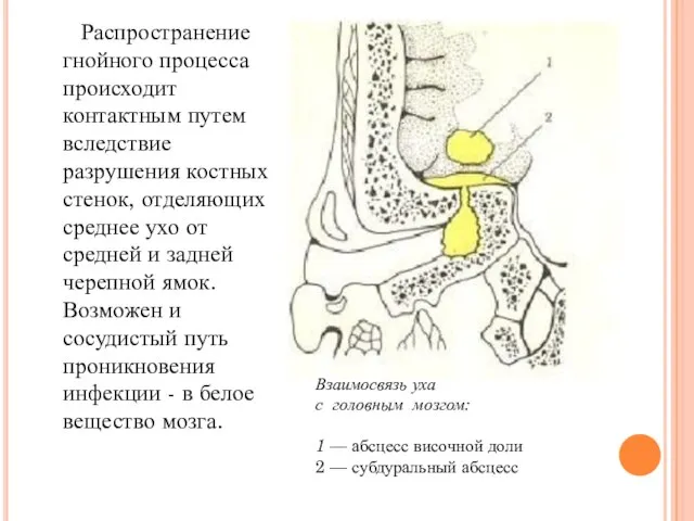 Распространение гнойного процесса происходит контактным путем вследствие разрушения костных стенок, отделяющих