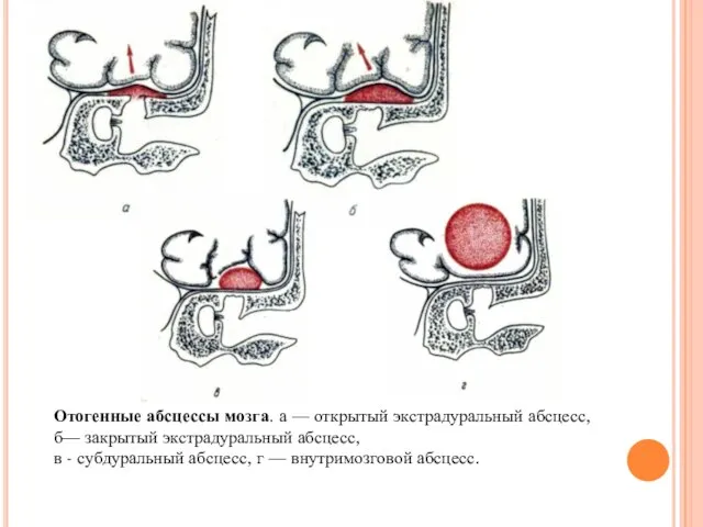 Отогенные абсцессы мозга. а — открытый экстрадуральный абсцесс, б— закрытый экстрадуральный