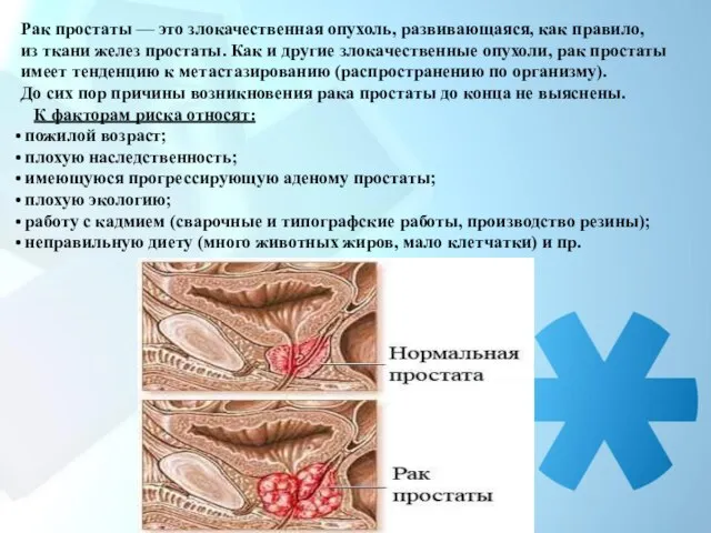 Рак простаты — это злокачественная опухоль, развивающаяся, как правило, из ткани