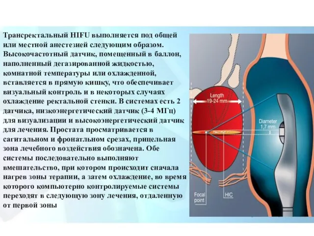 Трансректальный HIFU выполняется под общей или местной анестезией следующим образом. Высокочастотный