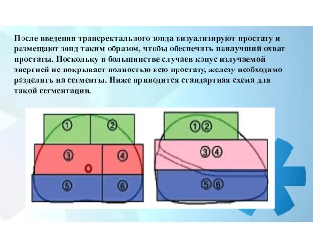 После введения трансректального зонда визуализируют простату и размещают зонд таким образом,