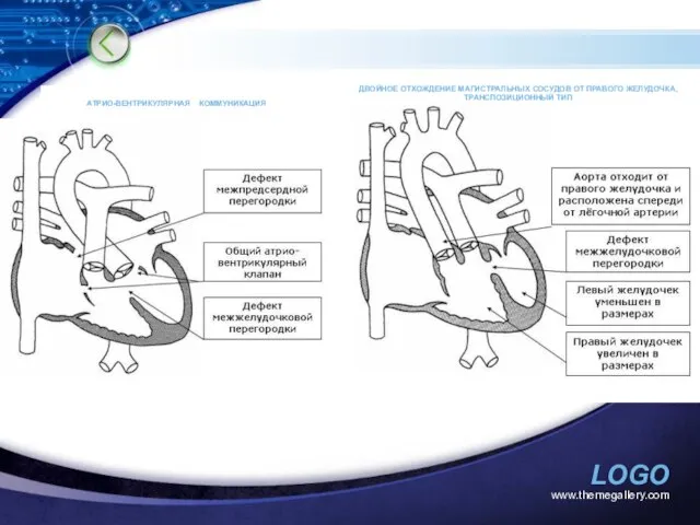 www.themegallery.com АТРИО-ВЕНТРИКУЛЯРНАЯ КОММУНИКАЦИЯ ДВОЙНОЕ ОТХОЖДЕНИЕ МАГИСТРАЛЬНЫХ СОСУДОВ ОТ ПРАВОГО ЖЕЛУДОЧКА, ТРАНСПОЗИЦИОННЫЙ ТИП