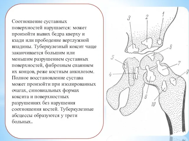 Соотношение суставных поверхностей нарушается: может произойти вывих бедра кверху и кзади