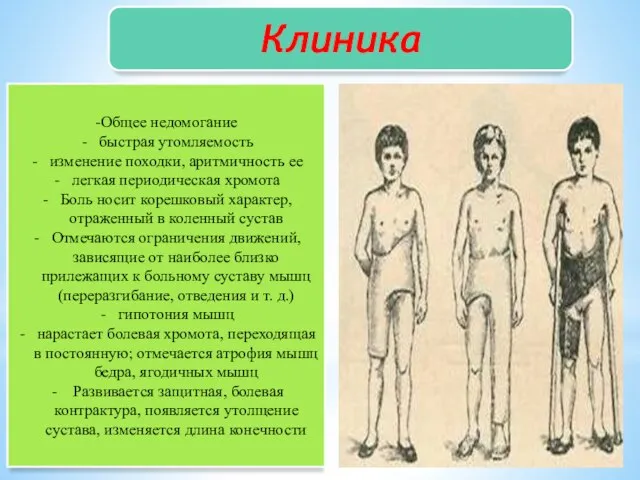 Клиника -Общее недомогание быстрая утомляемость изменение походки, аритмичность ее легкая периодическая