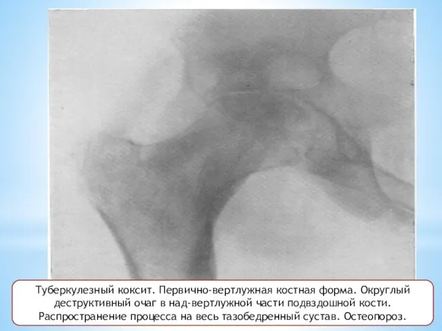 Туберкулезный коксит. Первично-вертлужная костная форма. Округлый деструктивный очаг в над-вертлужной части