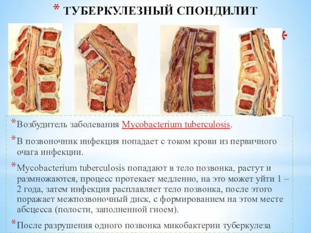 Возбудитель заболевания Mycobacterium tuberculosis. В позвоночник инфекция попадает с током крови