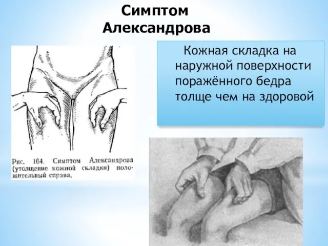 Кожная складка на наружной поверхности поражённого бедра толще чем на здоровой Симптом Александрова