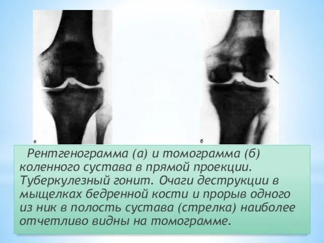 Рентгенограмма (а) и томограмма (б) коленного сустава в прямой проекции. Туберкулезный