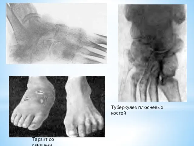 Тарзит со свищами Туберкулез плюсневых костей