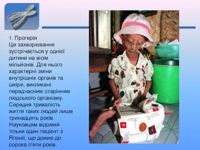 1. Прогерія Це захворювання зустрічається у однієї дитини на вісім мільйонів.