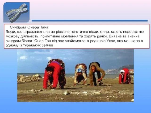 2. Синдром Юнера Тана Люди, що страждають на це рідкісне генетичне