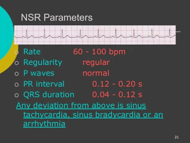 NSR Parameters Rate 60 - 100 bpm Regularity regular P waves