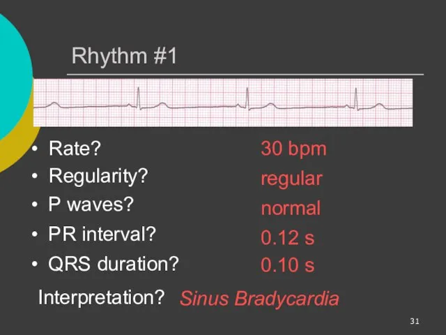 Rhythm #1 30 bpm Rate? Regularity? regular normal 0.10 s P