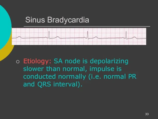 Sinus Bradycardia Etiology: SA node is depolarizing slower than normal, impulse