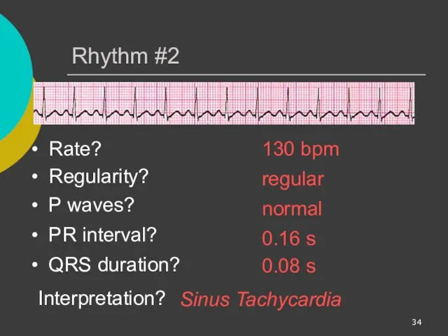 Rhythm #2 130 bpm Rate? Regularity? regular normal 0.08 s P