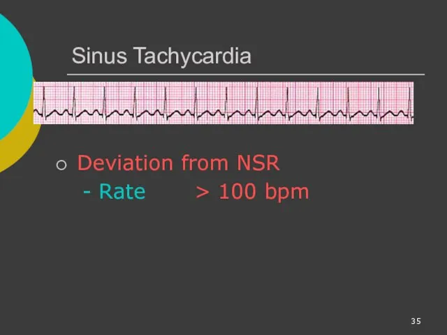 Sinus Tachycardia Deviation from NSR - Rate > 100 bpm