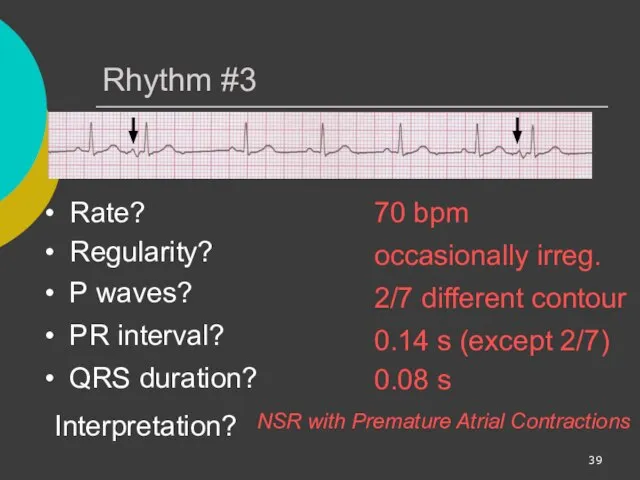 Rhythm #3 70 bpm Rate? Regularity? occasionally irreg. 2/7 different contour