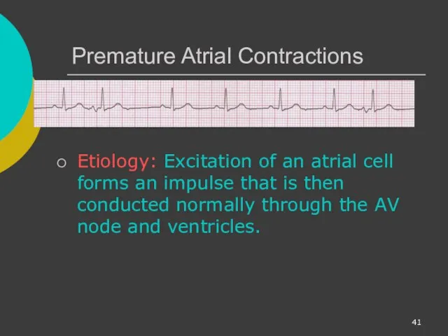 Premature Atrial Contractions Etiology: Excitation of an atrial cell forms an