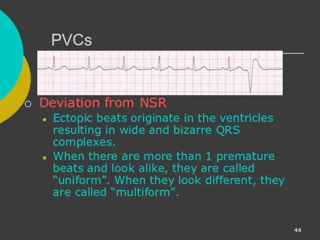 PVCs Deviation from NSR Ectopic beats originate in the ventricles resulting