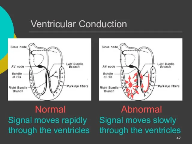 Ventricular Conduction Normal Signal moves rapidly through the ventricles Abnormal Signal moves slowly through the ventricles