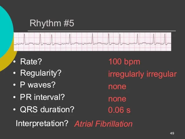 Rhythm #5 100 bpm Rate? Regularity? irregularly irregular none 0.06 s