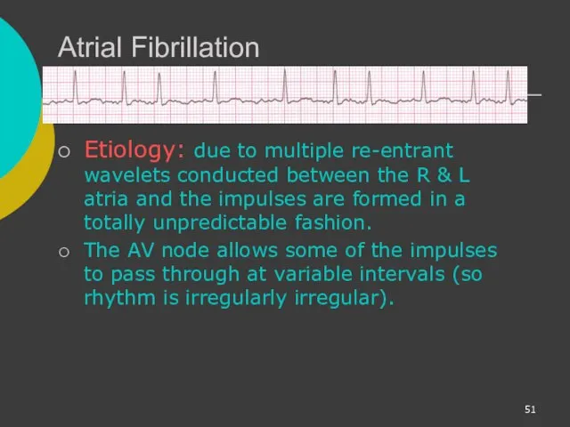 Atrial Fibrillation Etiology: due to multiple re-entrant wavelets conducted between the