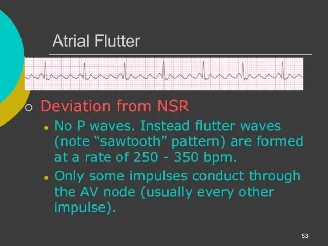 Atrial Flutter Deviation from NSR No P waves. Instead flutter waves