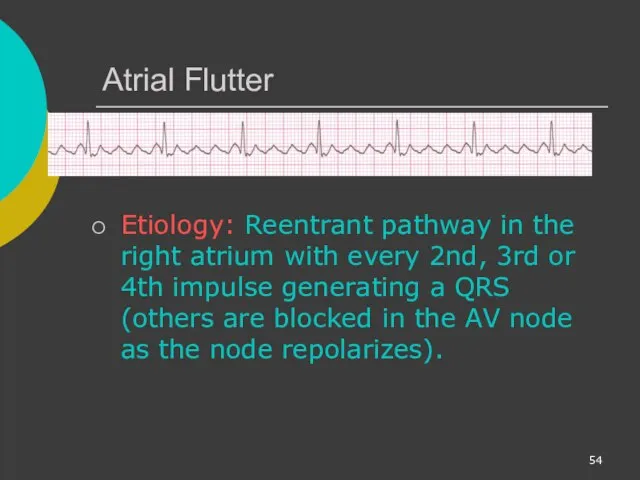 Atrial Flutter Etiology: Reentrant pathway in the right atrium with every