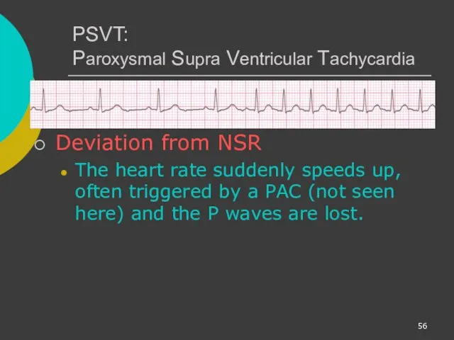 PSVT: Paroxysmal Supra Ventricular Tachycardia Deviation from NSR The heart rate