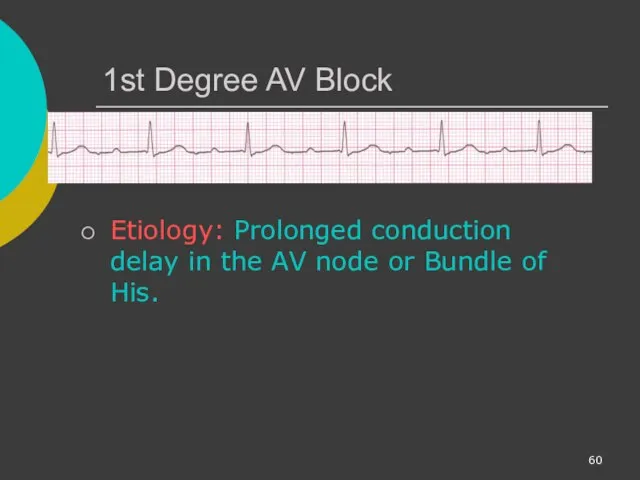 1st Degree AV Block Etiology: Prolonged conduction delay in the AV node or Bundle of His.