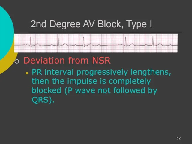 2nd Degree AV Block, Type I Deviation from NSR PR interval