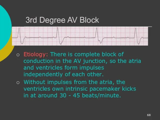 3rd Degree AV Block Etiology: There is complete block of conduction