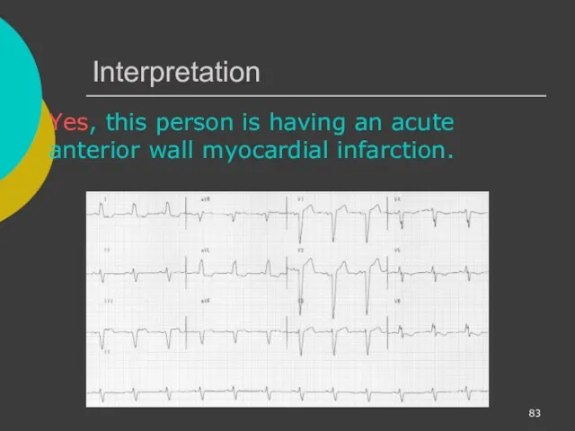 Interpretation Yes, this person is having an acute anterior wall myocardial infarction.