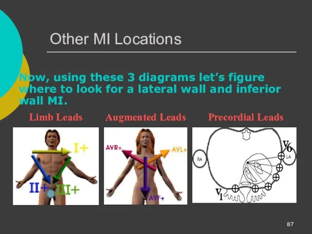 Other MI Locations Now, using these 3 diagrams let’s figure where