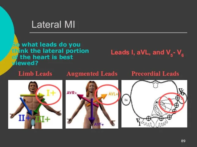 Lateral MI So what leads do you think the lateral portion