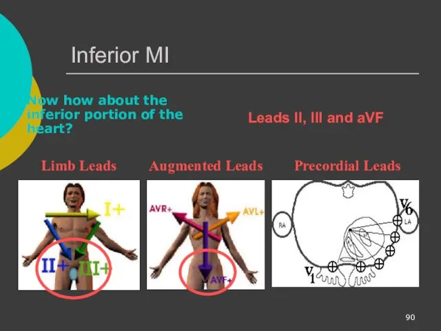 Inferior MI Now how about the inferior portion of the heart?