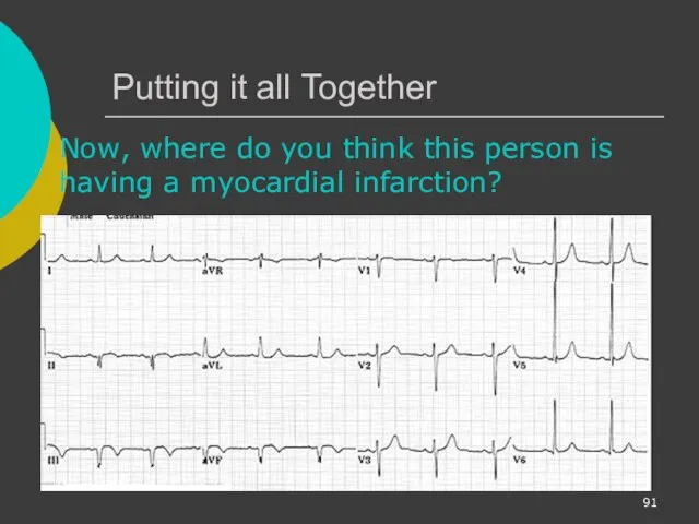 Putting it all Together Now, where do you think this person is having a myocardial infarction?