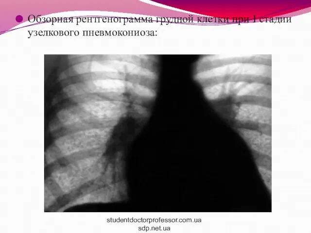 Обзорная рентгенограмма грудной клетки при I стадии узелкового пневмокониоза: studentdoctorprofessor.com.ua sdp.net.ua