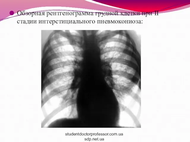 Обзорная рентгенограмма грудной клетки при II стадии интерстициального пневмокониоза: studentdoctorprofessor.com.ua sdp.net.ua