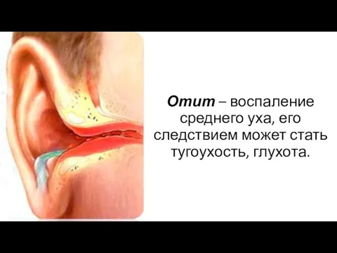 Отит – воспаление среднего уха, его следствием может стать тугоухость, глухота.