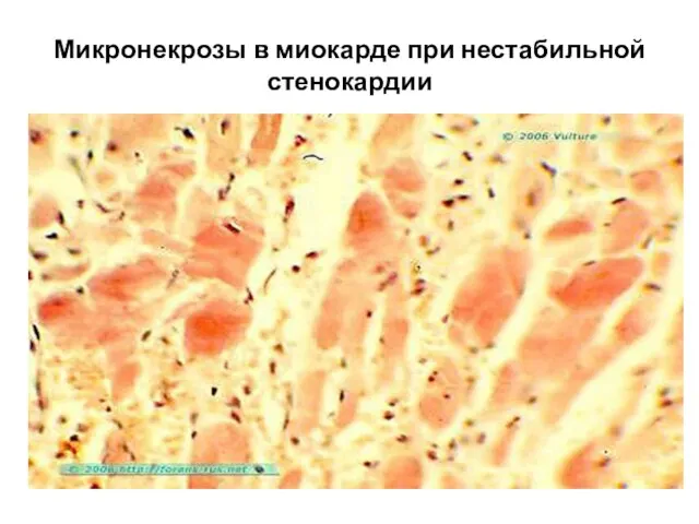 Микронекрозы в миокарде при нестабильной стенокардии