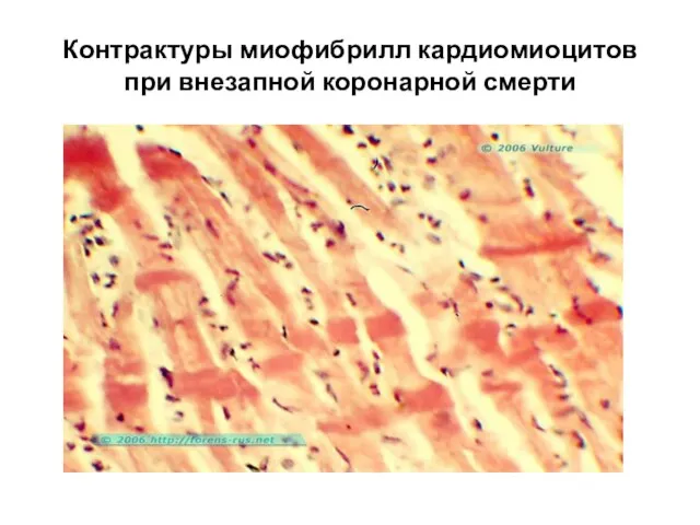 Контрактуры миофибрилл кардиомиоцитов при внезапной коронарной смерти