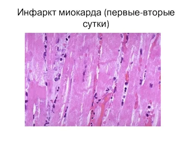 Инфаркт миокарда (первые-вторые сутки)