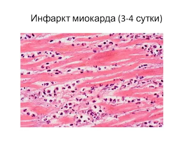 Инфаркт миокарда (3-4 сутки)