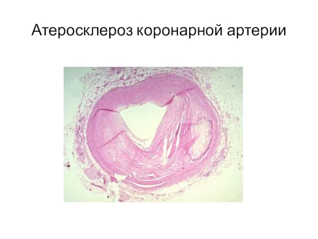 Атеросклероз коронарной артерии
