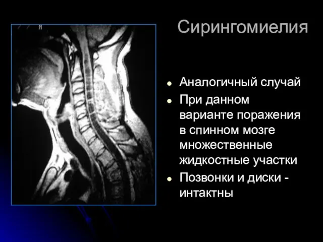 Сирингомиелия Аналогичный случай При данном варианте поражения в спинном мозге множественные