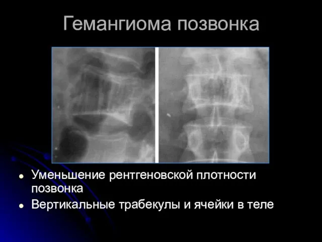 Гемангиома позвонка Уменьшение рентгеновской плотности позвонка Вертикальные трабекулы и ячейки в теле