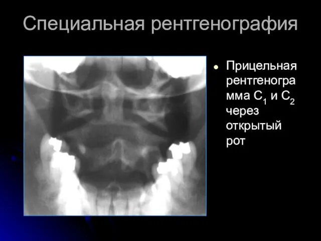 Специальная рентгенография Прицельная рентгенограмма С1 и С2 через открытый рот